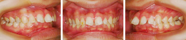 上顎前突症例（非抜歯）　治療前