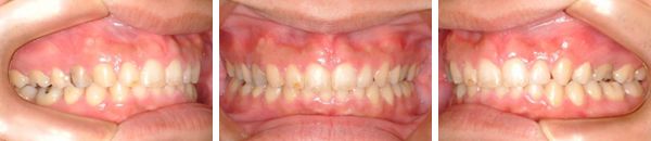 上顎前突症例（非抜歯）　治療後