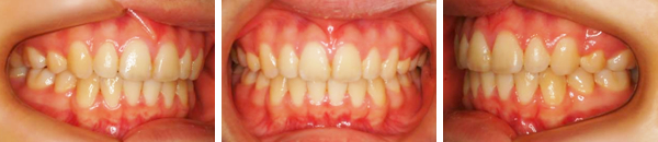 上顎前突症例（抜歯） 治療後