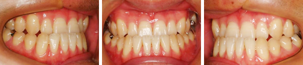 下顎前突症例（非抜歯）治療前