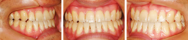 下顎前突症例（非抜歯）治療後