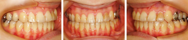 下顎前突症例（抜歯）治療後