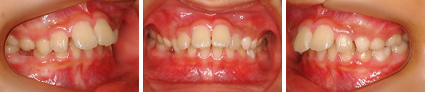 上顎前突症例（非抜歯）　治療前