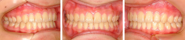 上顎前突症例（非抜歯）　治療後