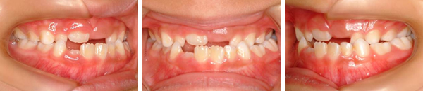 下顎前突症例（非抜歯）　治療前