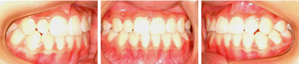 下顎前突症例（非抜歯）　治療後